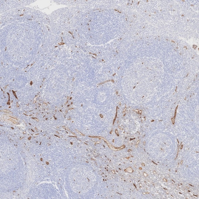 Immunohistochemistry (IHC) staining of human tonsillitis tissue using CD34 Recombinant monoclonal antibody (84242-5-RR)