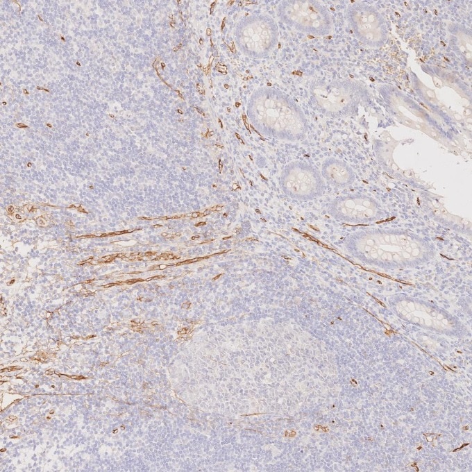 Immunohistochemistry (IHC) staining of human appendicitis tissue using CD34 Recombinant monoclonal antibody (84242-5-RR)
