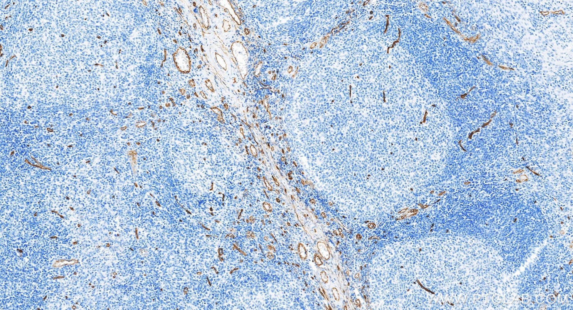 Immunohistochemical analysis of paraffin-embedded human tonsillitis tissue slide using 84242-5-RR (CD34 antibody) at dilution of 1:1000 (under 20x lens). Heat mediated antigen retrieval with Tris-EDTA buffer (pH 9.0). Immunohistochemistry (IHC) staining of human tonsillitis tissue using CD34 Recombinant monoclonal antibody (84242-5-RR)