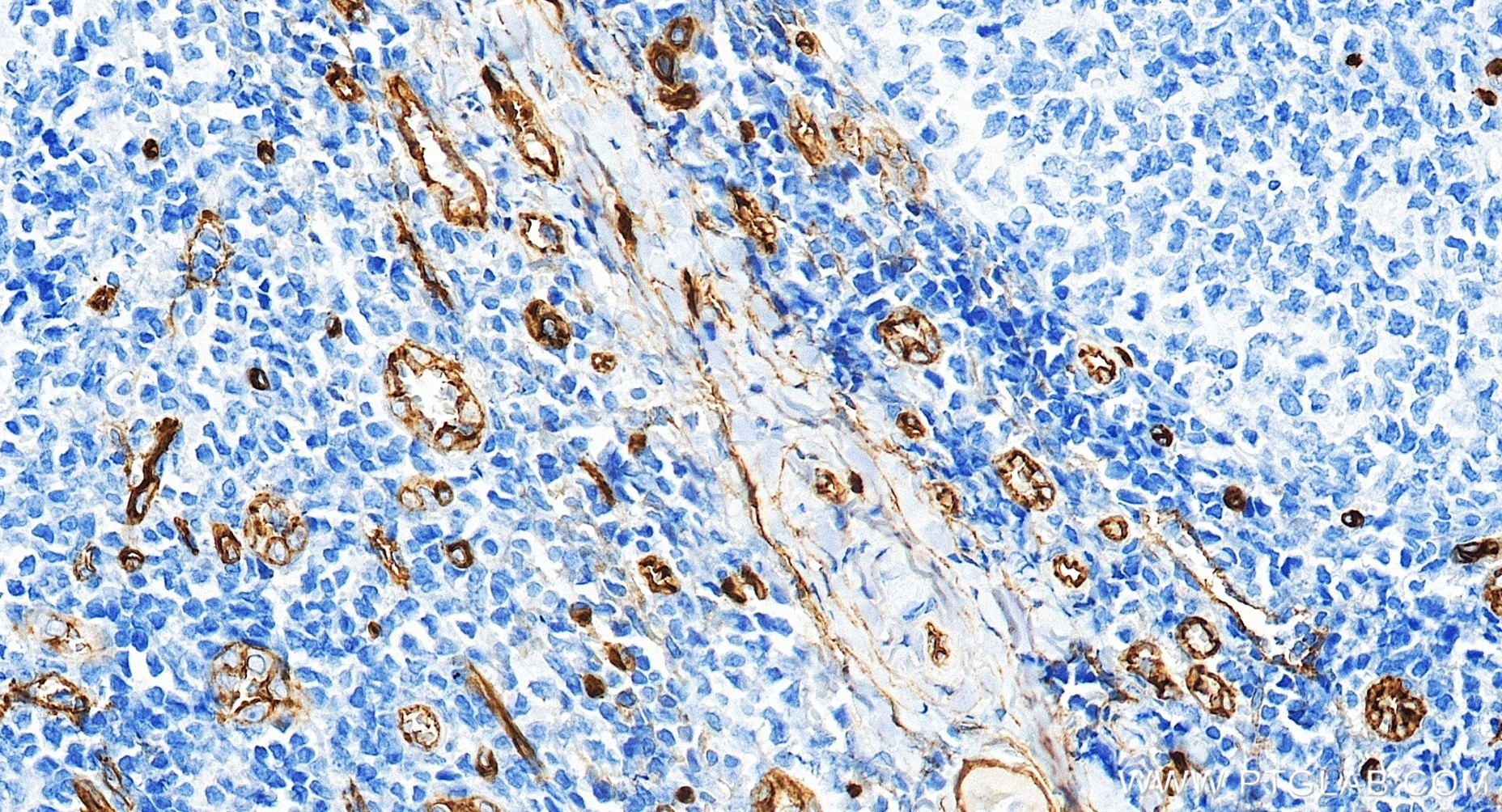 Immunohistochemical analysis of paraffin-embedded human tonsillitis tissue slide using 84242-5-RR (CD34 antibody) at dilution of 1:1000 (under 20x lens). Heat mediated antigen retrieval with Tris-EDTA buffer (pH 9.0). Immunohistochemistry (IHC) staining of human tonsillitis tissue using CD34 Recombinant monoclonal antibody (84242-5-RR)