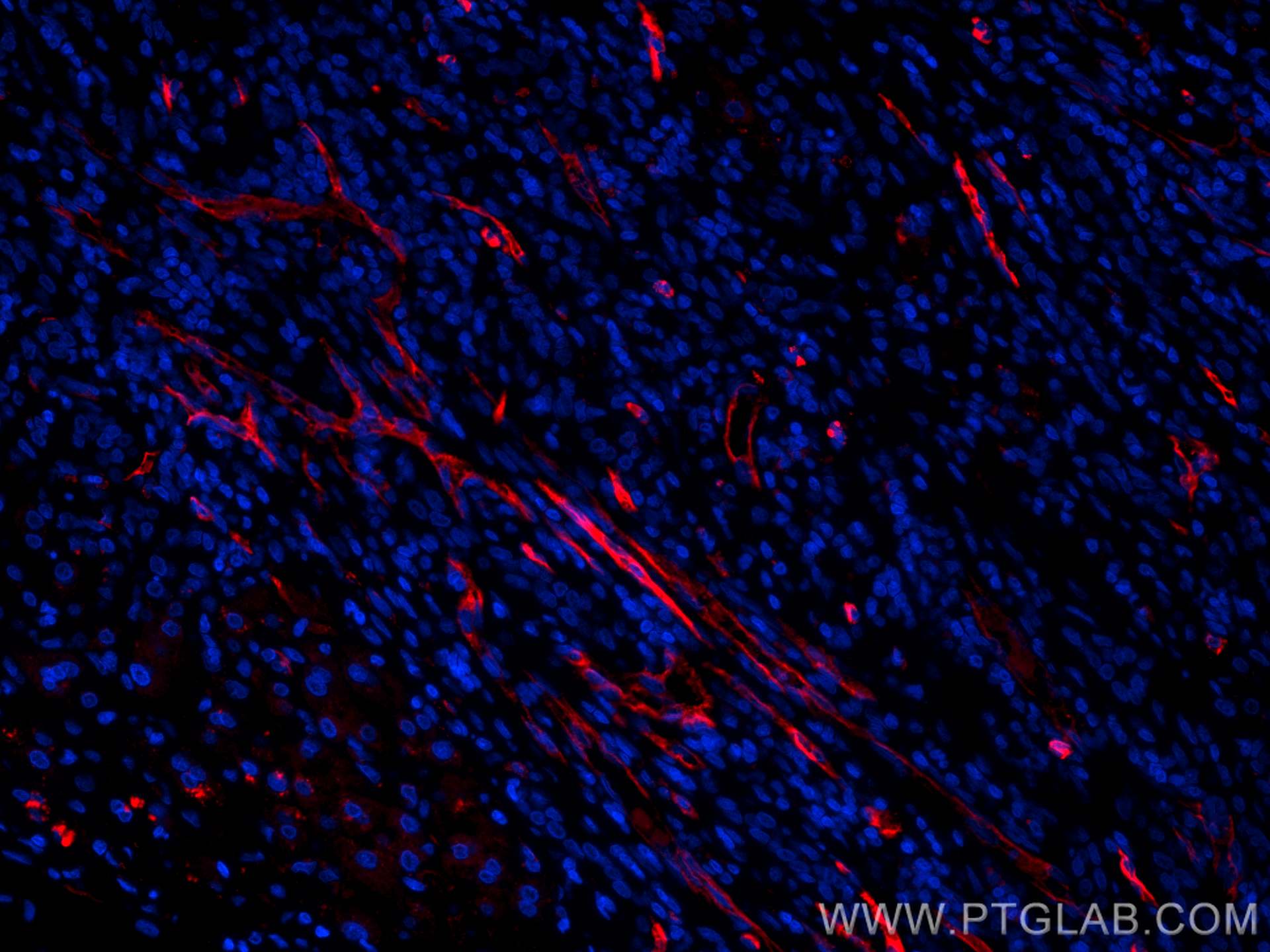 Immunofluorescence (IF) / fluorescent staining of human liver cancer tissue using CoraLite®594-conjugated CD34 Polyclonal antibody (CL594-14486)