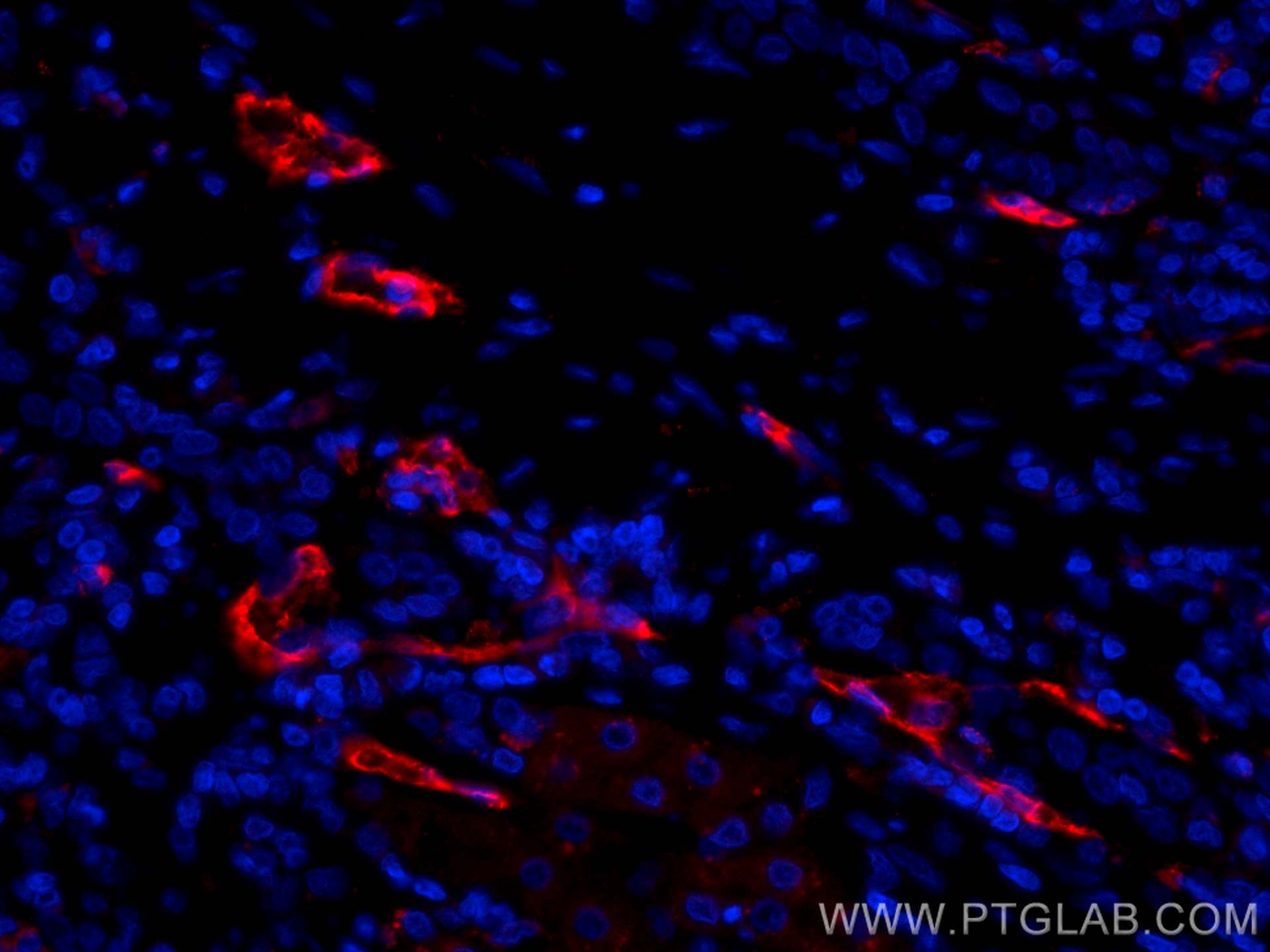 Immunofluorescence (IF) / fluorescent staining of human liver cancer tissue using CoraLite®594-conjugated CD34 Polyclonal antibody (CL594-14486)