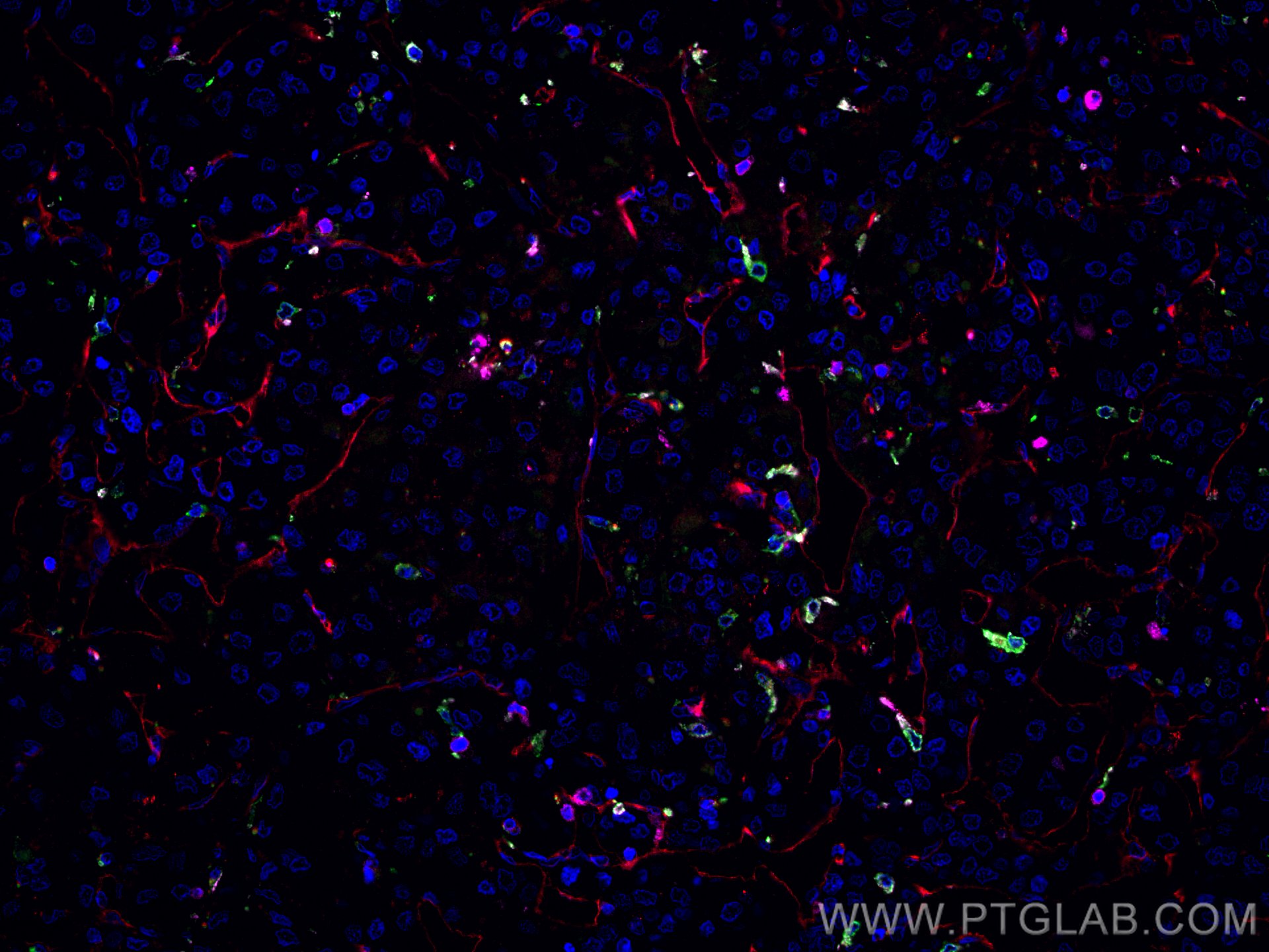 Immunofluorescence (IF) / fluorescent staining of human liver cancer tissue using CoraLite®594-conjugated CD34 Monoclonal antibody (CL594-60180)