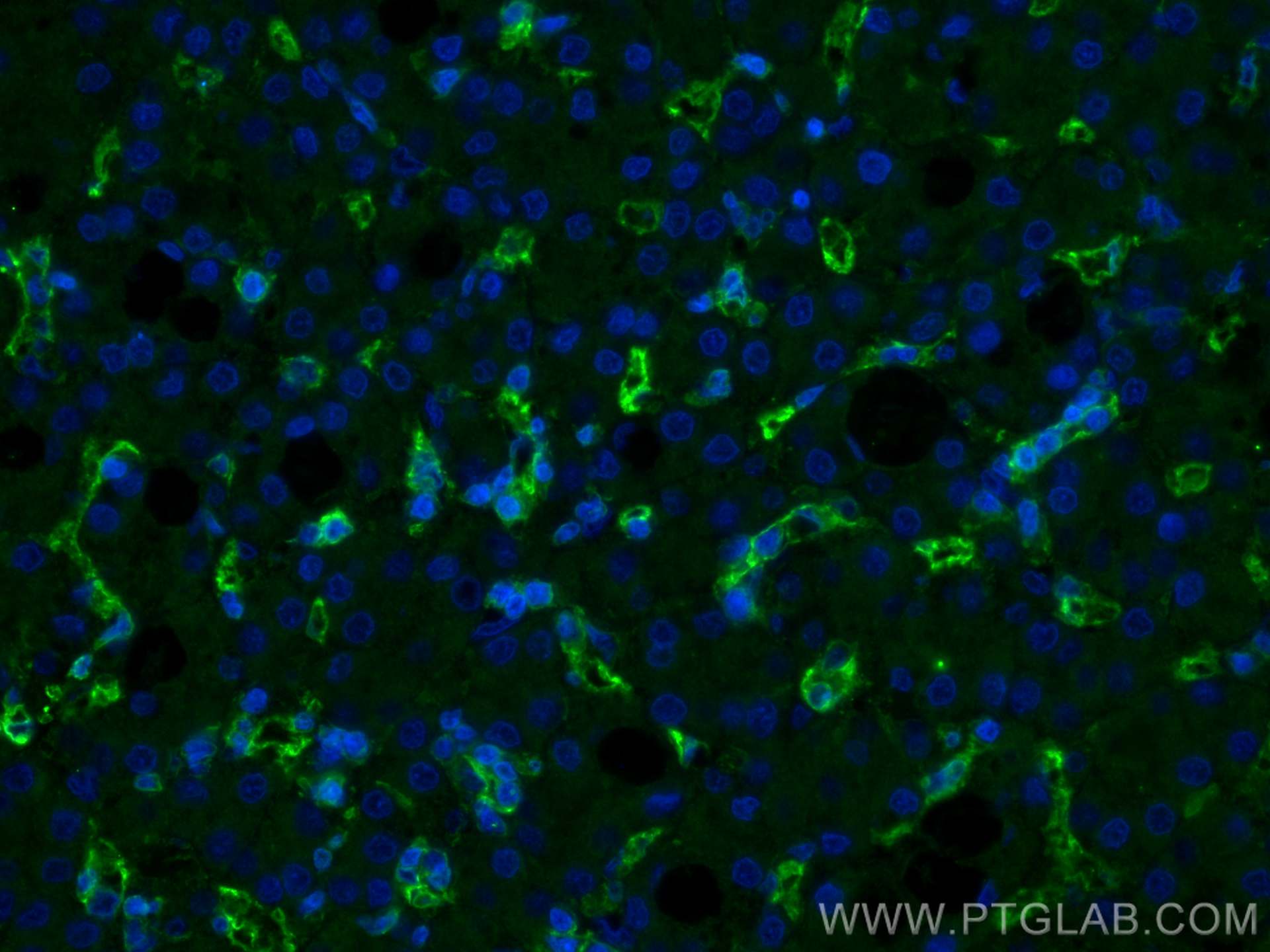 Immunofluorescence (IF) / fluorescent staining of human liver cancer tissue using CD36 Monoclonal antibody (66395-1-Ig)