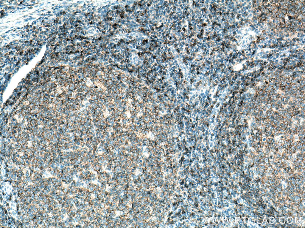 Immunohistochemistry (IHC) staining of human tonsillitis tissue using CD37 Polyclonal antibody (21044-1-AP)