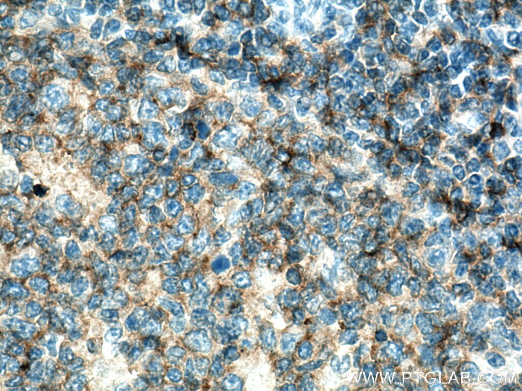 Immunohistochemistry (IHC) staining of human tonsillitis tissue using CD37 Polyclonal antibody (21044-1-AP)