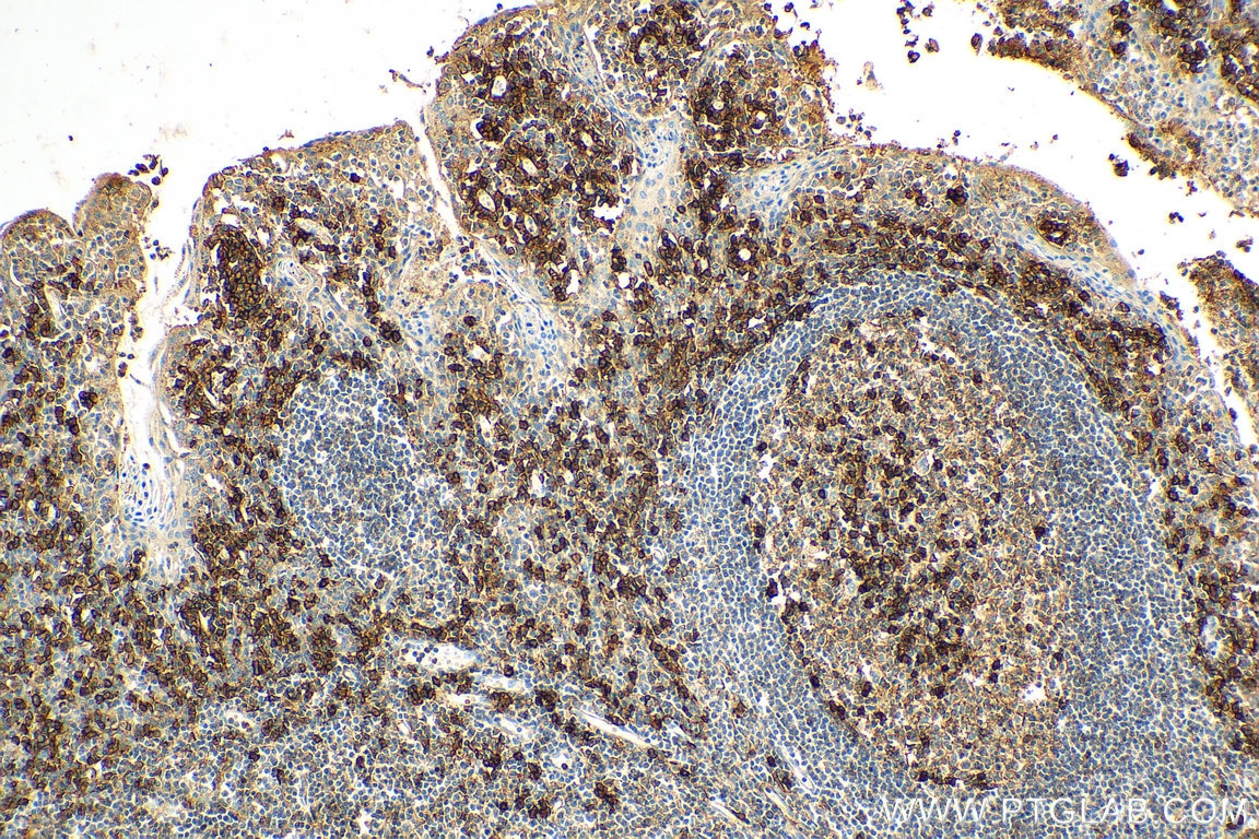 Immunohistochemistry (IHC) staining of human tonsillitis tissue using CD38 Polyclonal antibody (25284-1-AP)