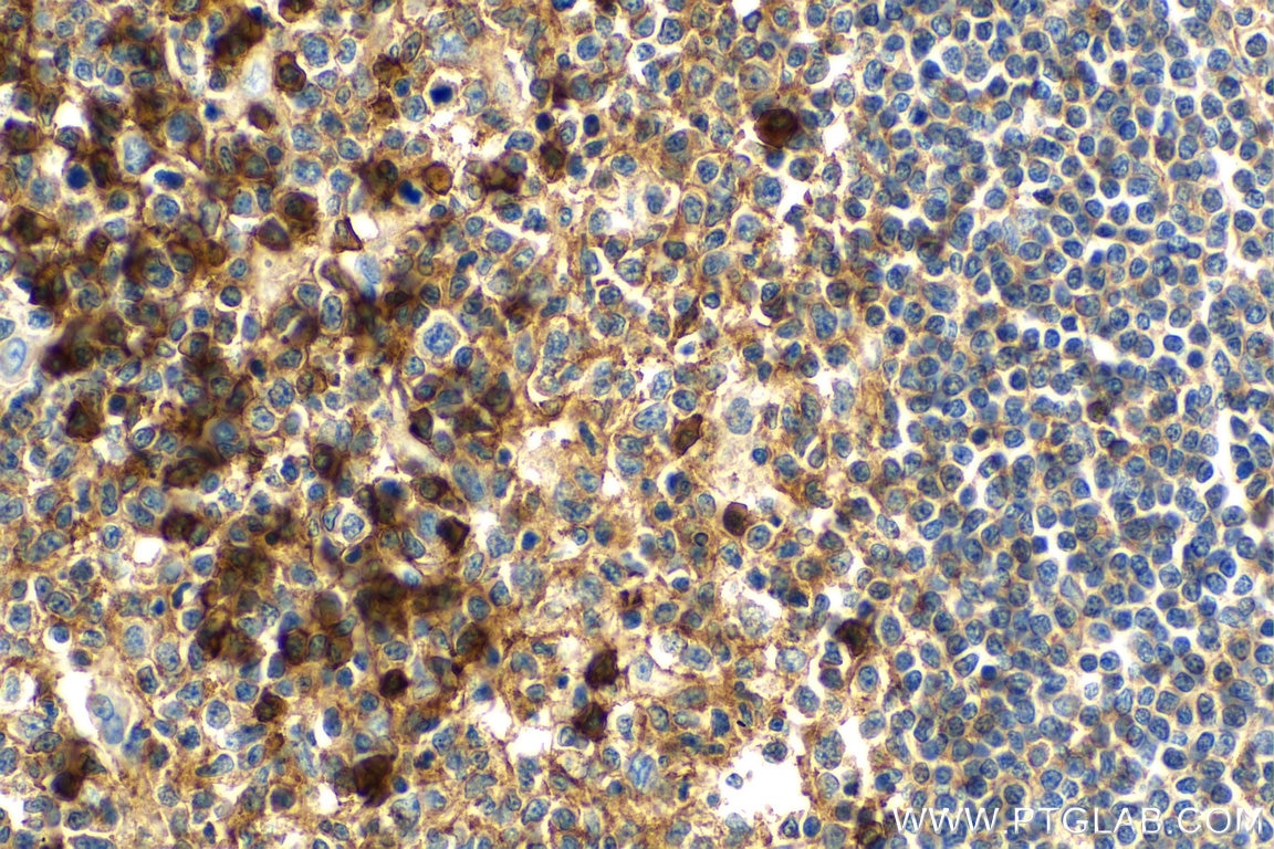 Immunohistochemistry (IHC) staining of human tonsillitis tissue using CD38 Polyclonal antibody (25284-1-AP)