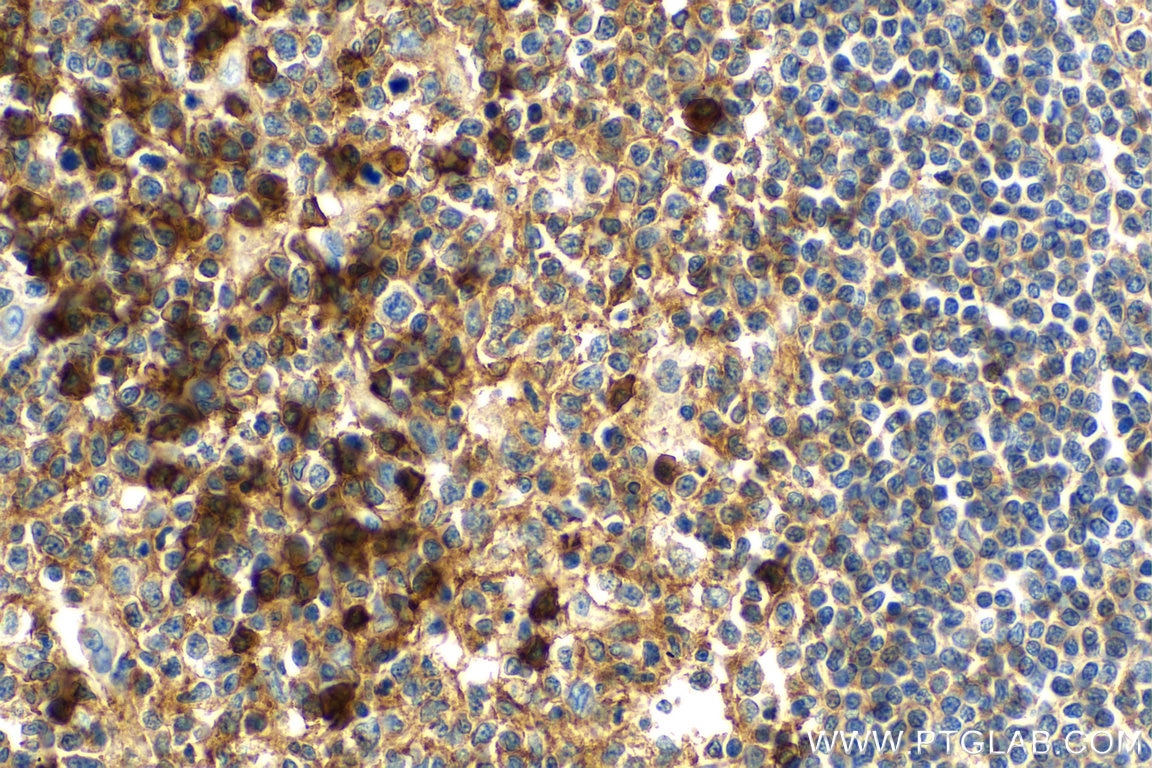 IHC staining of human tonsillitis using 25284-1-AP