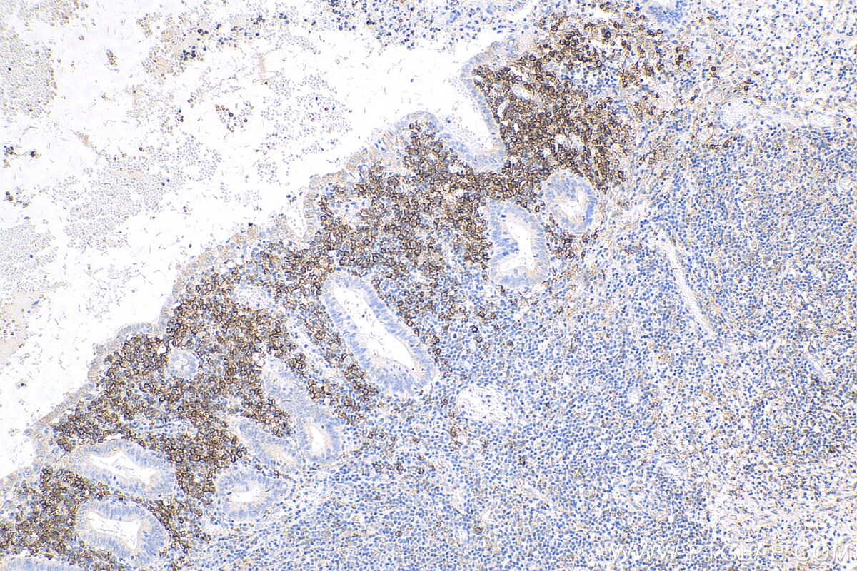 Immunohistochemistry (IHC) staining of human appendicitis tissue using CD38 Polyclonal antibody (25284-1-AP)