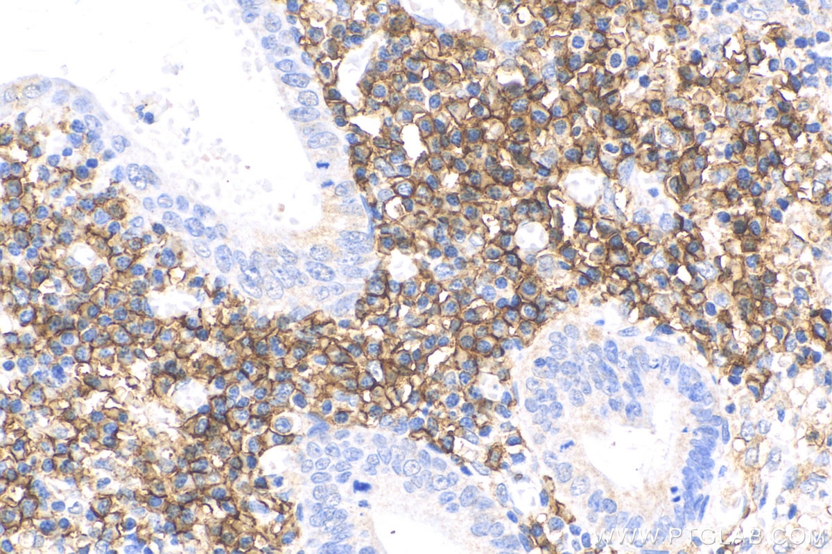 Immunohistochemistry (IHC) staining of human appendicitis tissue using CD38 Polyclonal antibody (25284-1-AP)