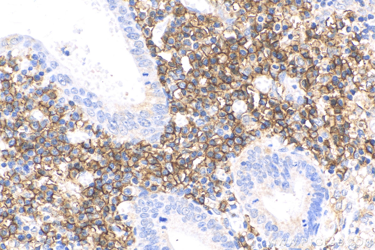 IHC staining of human appendicitis using 25284-1-AP