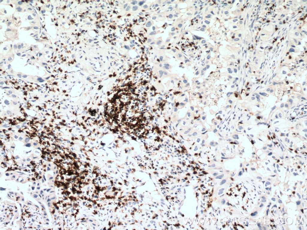 IHC staining of human lung cancer using 17617-1-AP