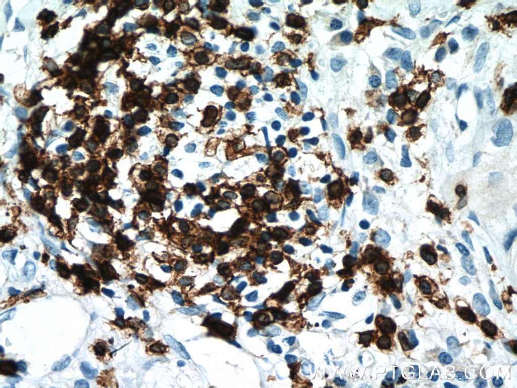 IHC staining of human lung cancer using 17617-1-AP