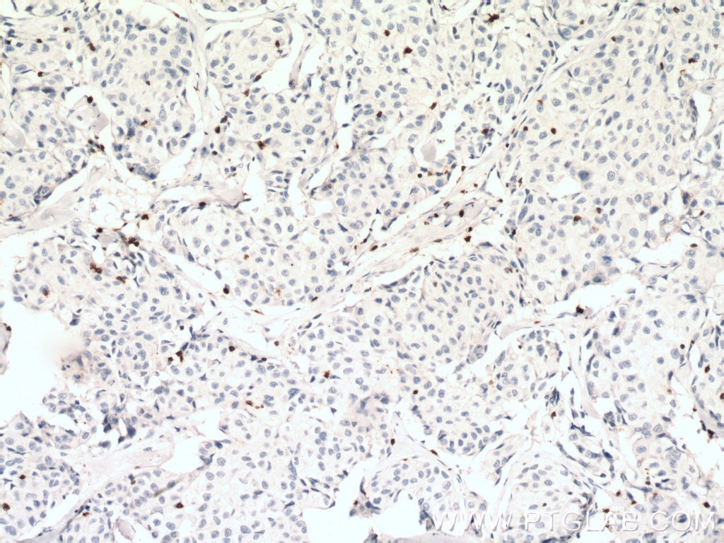 Immunohistochemistry (IHC) staining of human lung cancer tissue using CD3 Polyclonal antibody (17617-1-AP)