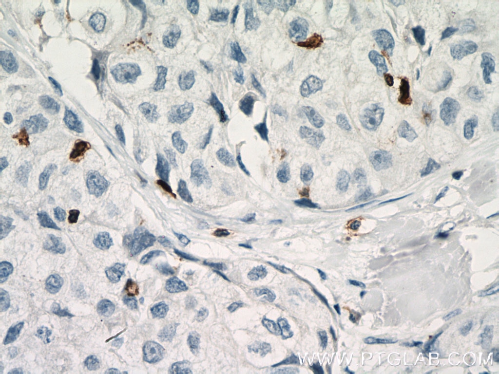 IHC staining of human lung cancer using 17617-1-AP