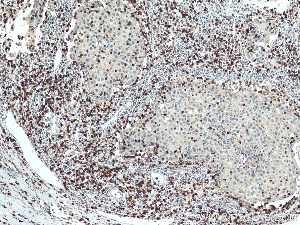 Immunohistochemistry (IHC) staining of human breast cancer tissue using CD3 Polyclonal antibody (17617-1-AP)