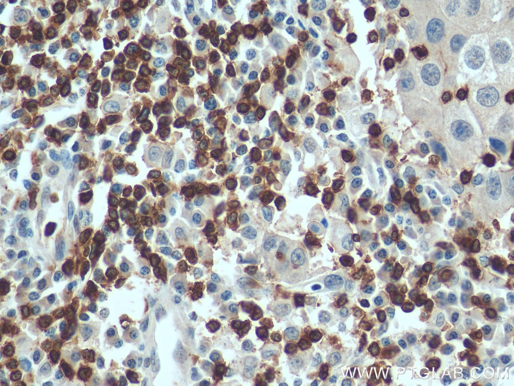 Immunohistochemistry (IHC) staining of human breast cancer tissue using CD3 Polyclonal antibody (17617-1-AP)