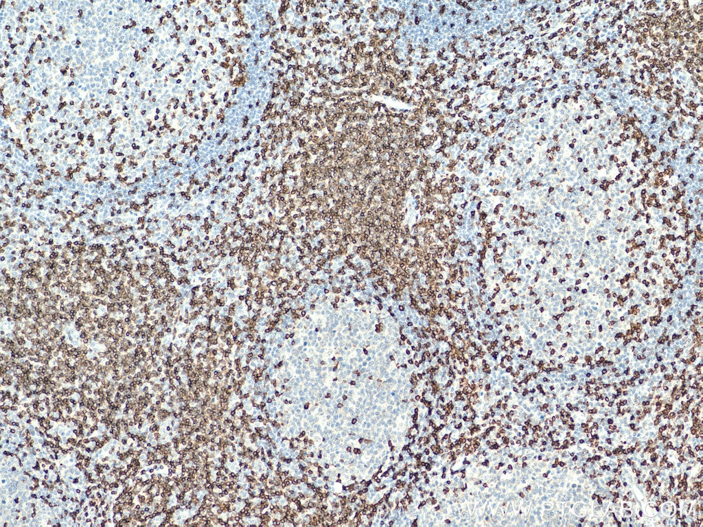 Immunohistochemistry (IHC) staining of human tonsillitis tissue using CD3 Polyclonal antibody (17617-1-AP)