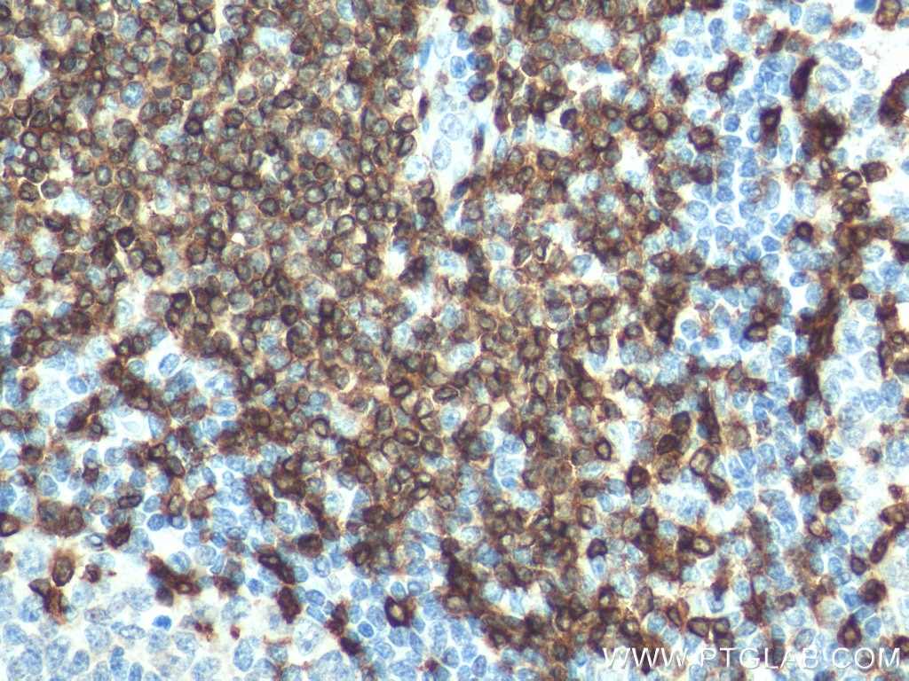 Immunohistochemistry (IHC) staining of human tonsillitis tissue using CD3 Polyclonal antibody (17617-1-AP)