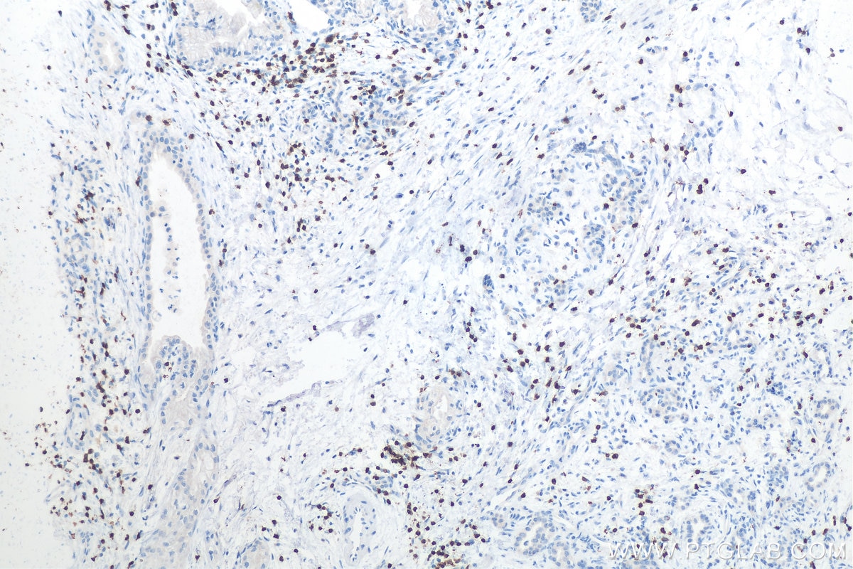 Immunohistochemistry (IHC) staining of human pancreas cancer tissue using CD3 Polyclonal antibody (17617-1-AP)