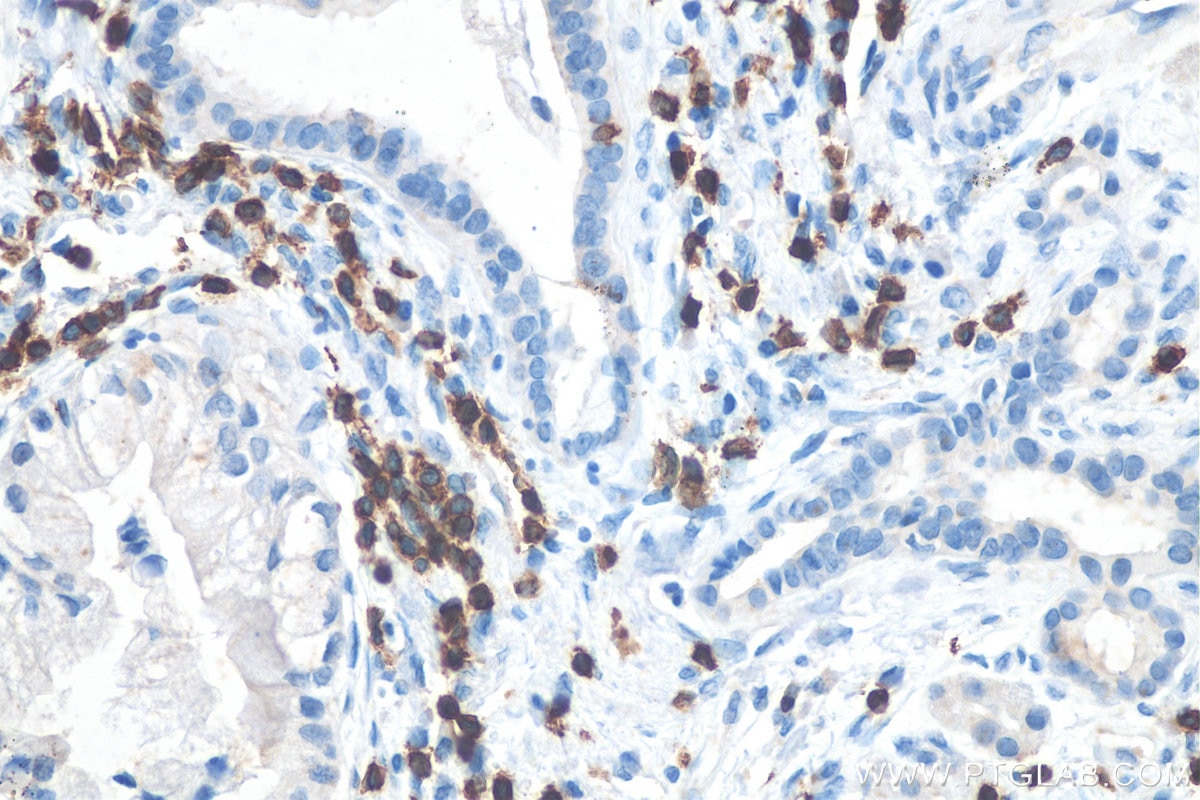 Immunohistochemistry (IHC) staining of human pancreas cancer tissue using CD3 Polyclonal antibody (17617-1-AP)