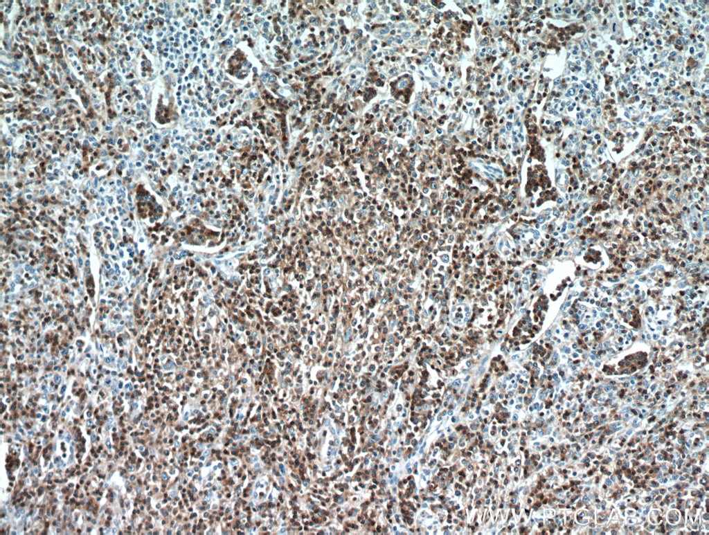 Immunohistochemistry (IHC) staining of human lymphoma tissue using CD3 Polyclonal antibody (17617-1-AP)