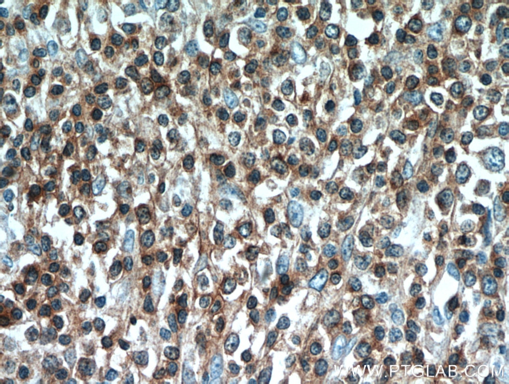 Immunohistochemistry (IHC) staining of human lymphoma tissue using CD3 Polyclonal antibody (17617-1-AP)