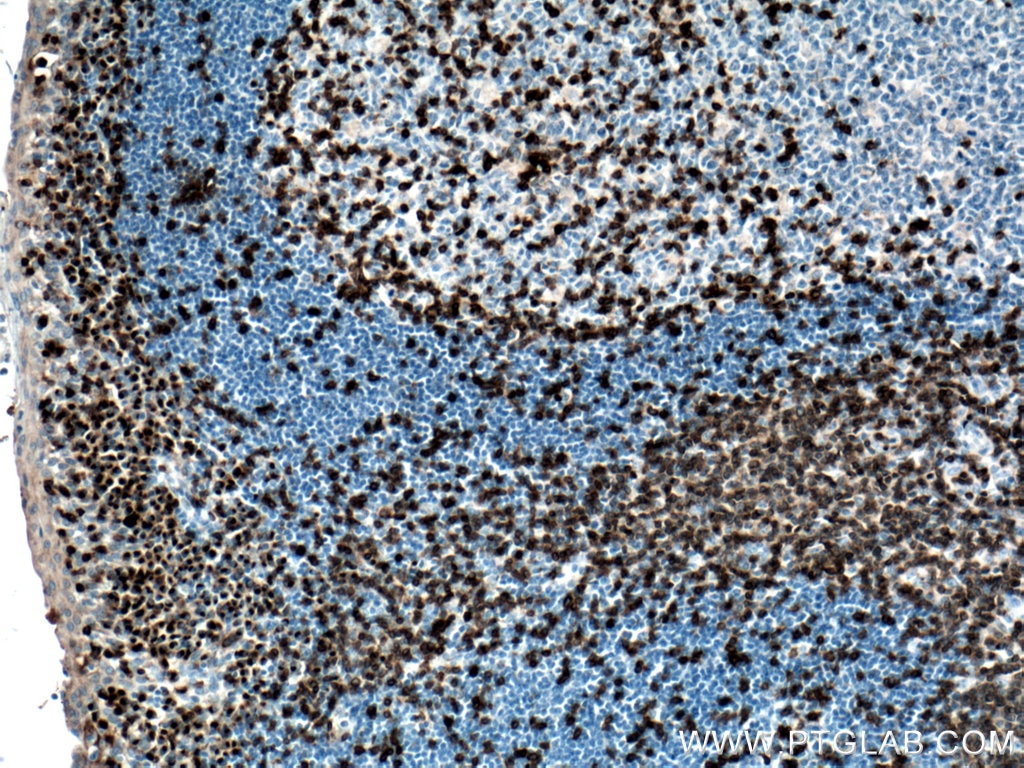 Immunohistochemistry (IHC) staining of human tonsillitis tissue using CD3 Monoclonal antibody (60181-1-Ig)