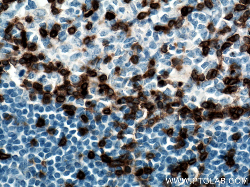 Immunohistochemistry (IHC) staining of human tonsillitis tissue using CD3 Monoclonal antibody (60181-1-Ig)