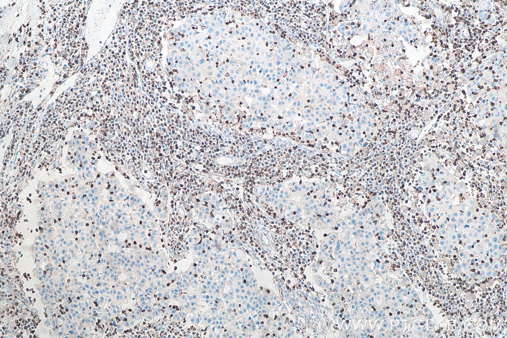 IHC staining of human breast cancer using 60181-1-Ig Immunohistochemistry (IHC) staining of human breast cancer tissue using CD3 Monoclonal antibody (60181-1-Ig)