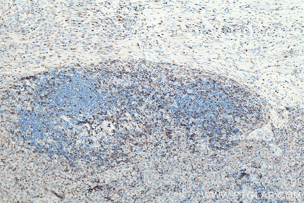 IHC staining of human lymphoma using 60181-1-Ig Immunohistochemistry (IHC) staining of human lymphoma tissue using CD3 Monoclonal antibody (60181-1-Ig)