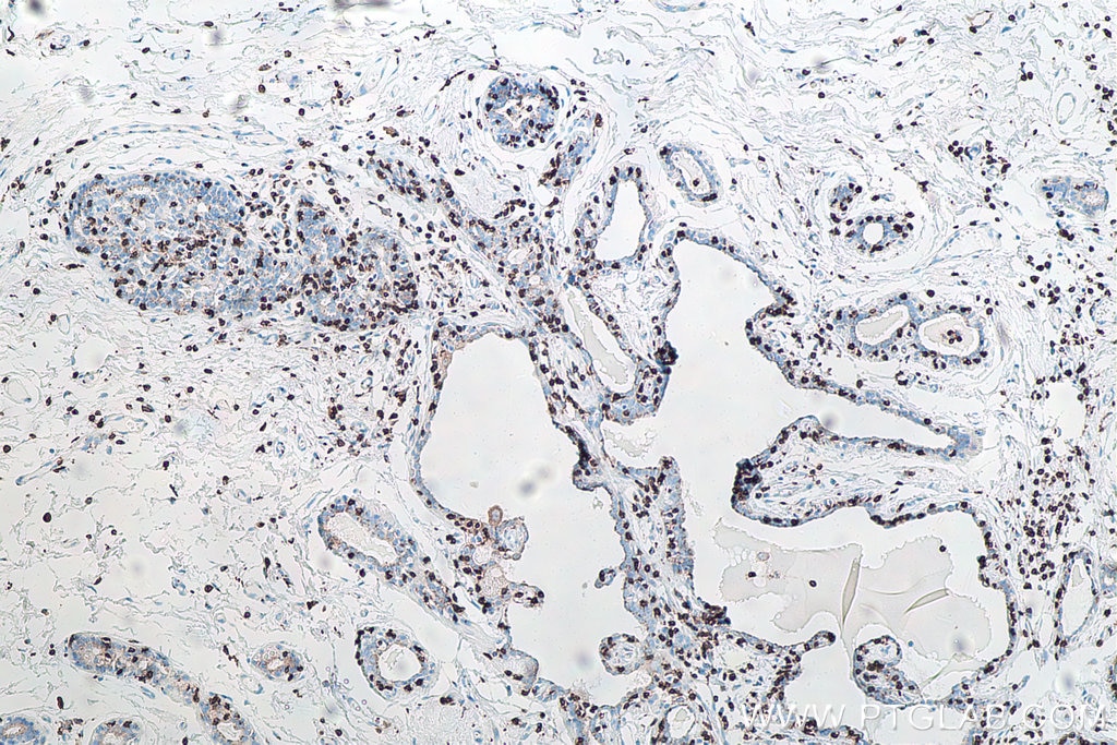 IHC staining of human breast cancer using 60181-1-Ig Immunohistochemistry (IHC) staining of human breast cancer tissue using CD3 Monoclonal antibody (60181-1-Ig)