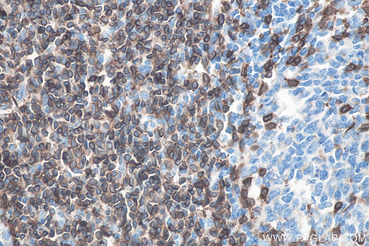 IHC staining of human tonsillitis using 60181-1-Ig Immunohistochemistry (IHC) staining of human tonsillitis tissue using CD3 Monoclonal antibody (60181-1-Ig)