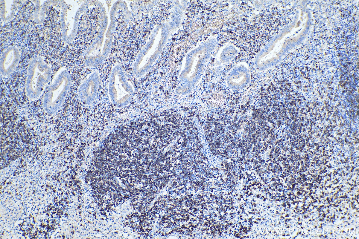 IHC staining of human appendicitis using 60181-1-Ig Immunohistochemistry (IHC) staining of human appendicitis tissue using CD3 Monoclonal antibody (60181-1-Ig)