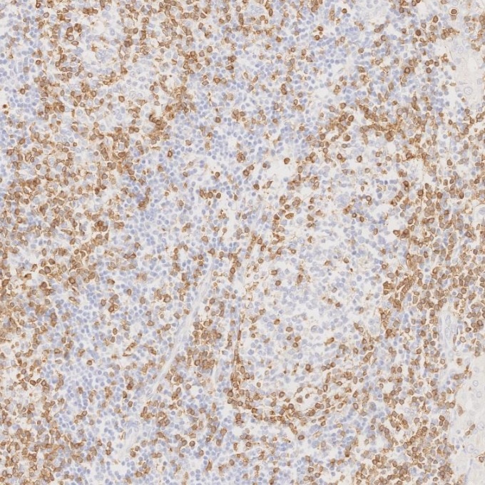 IHC staining of human lymphoma using 60181-1-Ig Immunohistochemistry (IHC) staining of human lymphoma tissue using CD3 Monoclonal antibody (60181-1-Ig)