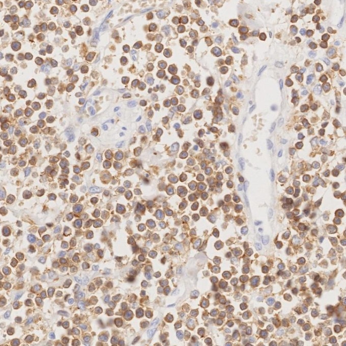 IHC staining of human lymphoma using 60181-1-Ig Immunohistochemistry (IHC) staining of human lymphoma tissue using CD3 Monoclonal antibody (60181-1-Ig)