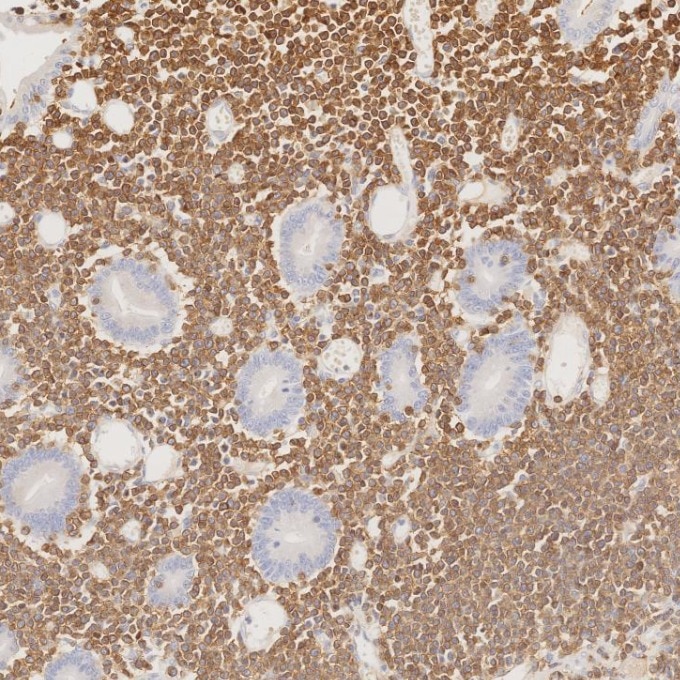 IHC staining of human lymphoma using 60181-1-Ig Immunohistochemistry (IHC) staining of human lymphoma tissue using CD3 Monoclonal antibody (60181-1-Ig)