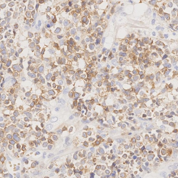IHC staining of human lymphoma using 60181-1-Ig Immunohistochemistry (IHC) staining of human lymphoma tissue using CD3 Monoclonal antibody (60181-1-Ig)