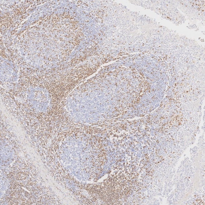 IHC staining of human tonsillitis using 60181-1-Ig Immunohistochemistry (IHC) staining of human tonsillitis tissue using CD3 Monoclonal antibody (60181-1-Ig)