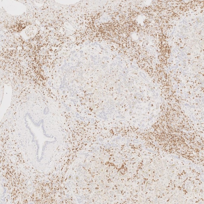 IHC staining of human liver using 60181-1-Ig Immunohistochemistry (IHC) staining of human liver tissue using CD3 Monoclonal antibody (60181-1-Ig)