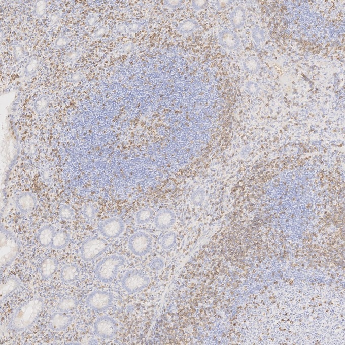 IHC staining of human appendicitis using 60181-1-Ig Immunohistochemistry (IHC) staining of human appendicitis tissue using CD3 Monoclonal antibody (60181-1-Ig)