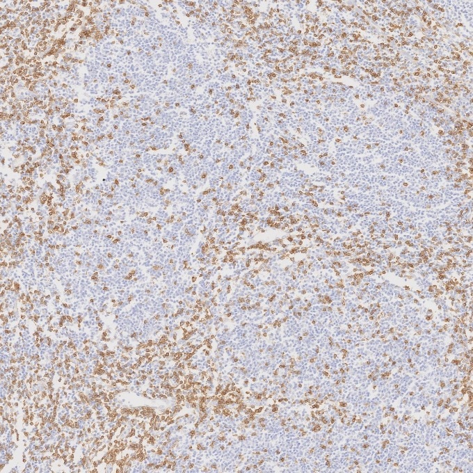 IHC staining of human lymphoma using 60181-1-Ig Immunohistochemistry (IHC) staining of human lymphoma tissue using CD3 Monoclonal antibody (60181-1-Ig)