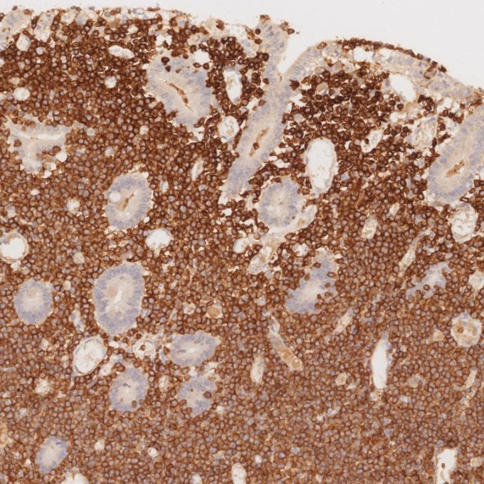 IHC staining of human lymphoma using 60181-1-Ig Immunohistochemistry (IHC) staining of human lymphoma tissue using CD3 Monoclonal antibody (60181-1-Ig)