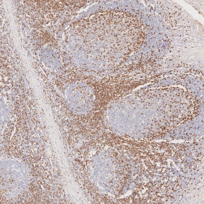 IHC staining of human tonsillitis using 60181-1-Ig Immunohistochemistry (IHC) staining of human tonsillitis tissue using CD3 Monoclonal antibody (60181-1-Ig)