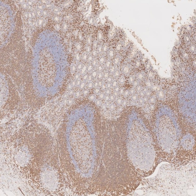 IHC staining of human appendicitis using 60181-1-Ig Immunohistochemistry (IHC) staining of human appendicitis tissue using CD3 Monoclonal antibody (60181-1-Ig)