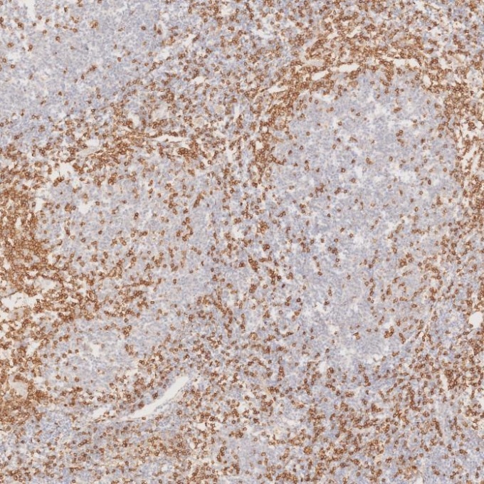 IHC staining of human lymphoma using 60181-1-Ig Immunohistochemistry (IHC) staining of human lymphoma tissue using CD3 Monoclonal antibody (60181-1-Ig)