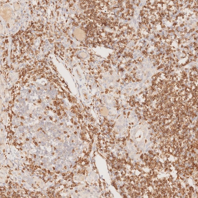 IHC staining of human lymphoma using 60181-1-Ig Immunohistochemistry (IHC) staining of human lymphoma tissue using CD3 Monoclonal antibody (60181-1-Ig)