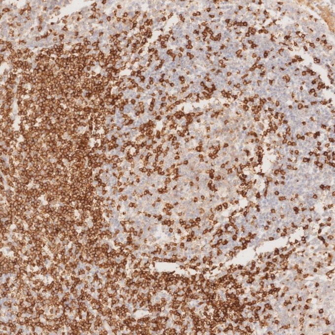 IHC staining of human tonsillitis using 60181-1-Ig Immunohistochemistry (IHC) staining of human tonsillitis tissue using CD3 Monoclonal antibody (60181-1-Ig)