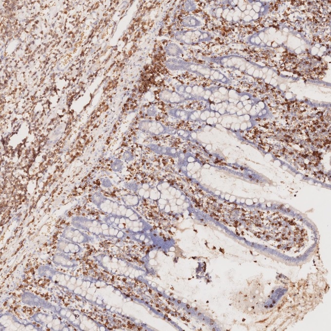 IHC staining of human lymphoma using 60181-1-Ig Immunohistochemistry (IHC) staining of human lymphoma tissue using CD3 Monoclonal antibody (60181-1-Ig)